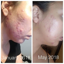 Load image into Gallery viewer, Acne-Fighting Face Oil - Natural Acne Treatment - Organic Acne Serum - Blemish And Scar Remover - Facial Oil For Acne-Prone Skin - Natural Scar Treatment - Antioxidant Facial Serum - Best Oil For Acne Scars - Oil Serum For Acne And Blemishes
