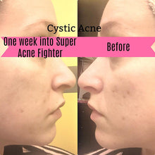 Load image into Gallery viewer, Acne-Fighting Face Oil - Natural Acne Treatment - Organic Acne Serum - Blemish And Scar Remover - Facial Oil For Acne-Prone Skin - Natural Scar Treatment - Antioxidant Facial Serum - Best Oil For Acne Scars - Oil Serum For Acne And Blemishes